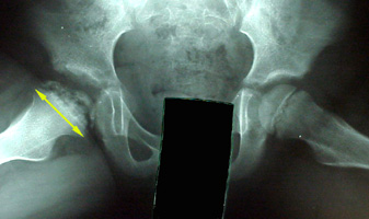 Legg-Calve-Perthes_Disease (3).jpg